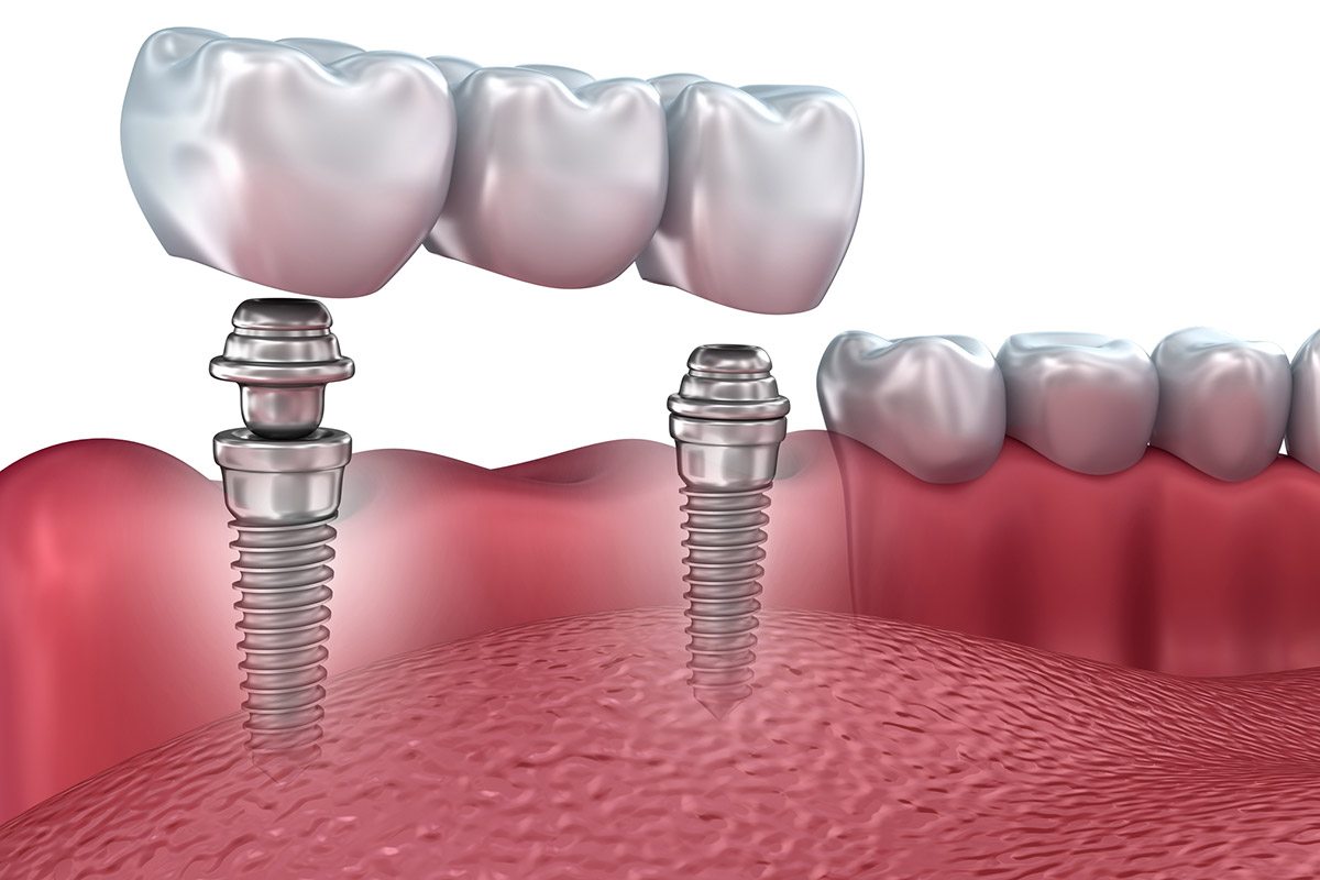 Full Arch Implants vs Dentures