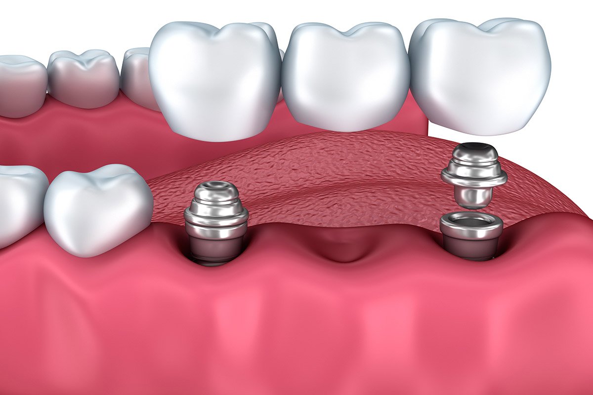 How to Care for Dental Implants