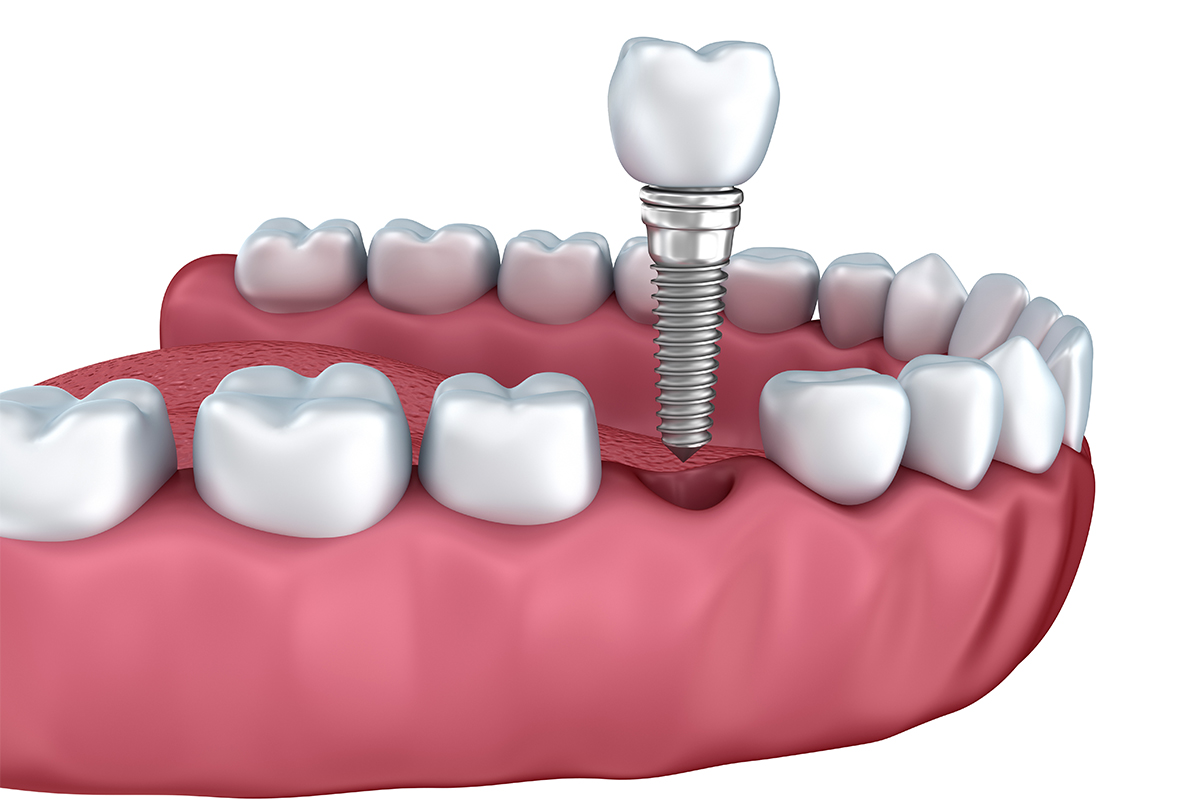 Permanent Teeth Implants in Livermore CA Area
