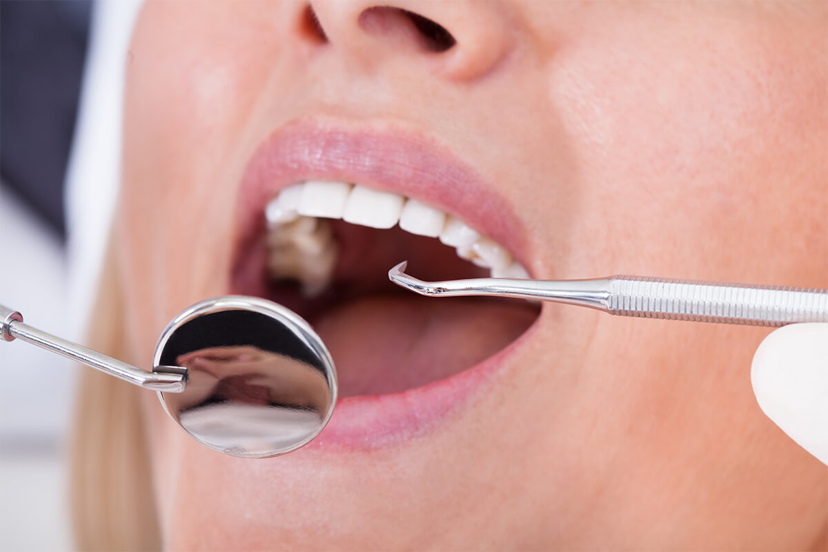 Surgical Removal of Teeth in Livermore CA Area